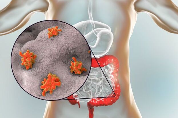 vrste parazita u ljudskom tijelu